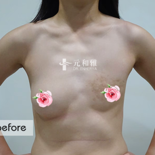 台南珍珠波隆乳