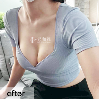 珍珠波隆乳心得