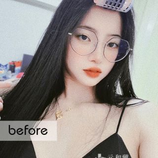 女王波隆乳手術術前