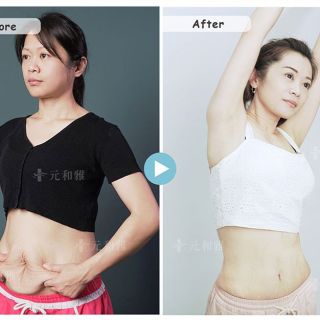 三寶媽的腹部拉皮與環抽心得1