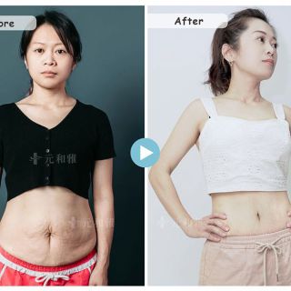 三寶媽的腹部拉皮與環抽心得2