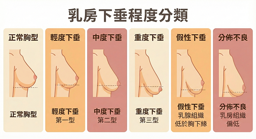 乳房下垂程度分類一元和雅整形外科診所
