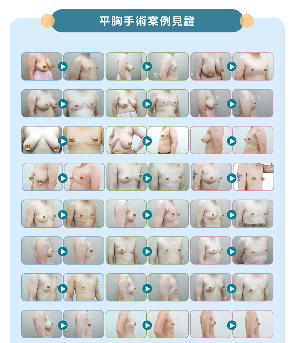 平胸手術/術前術後