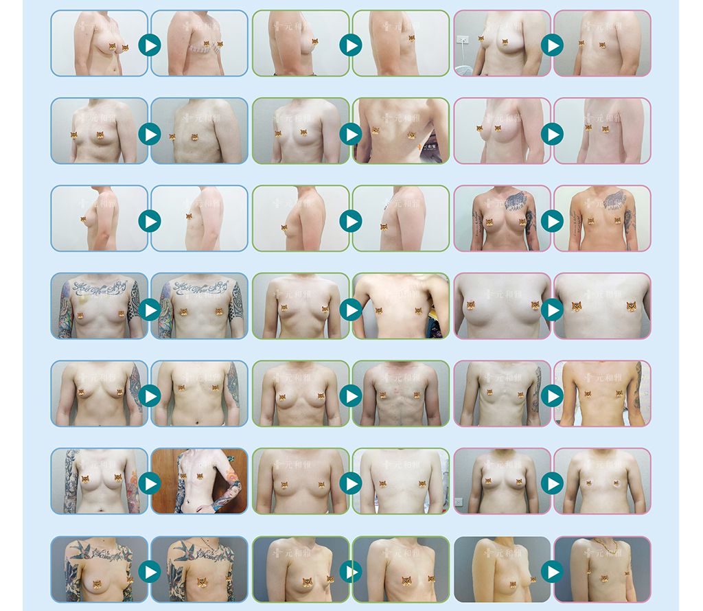 平胸手術/術前術後