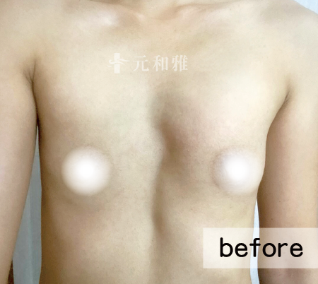 漏斗胸術前