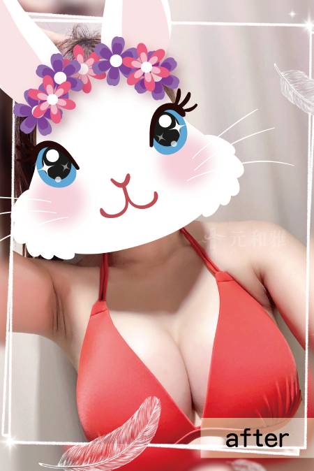 漏斗胸術後