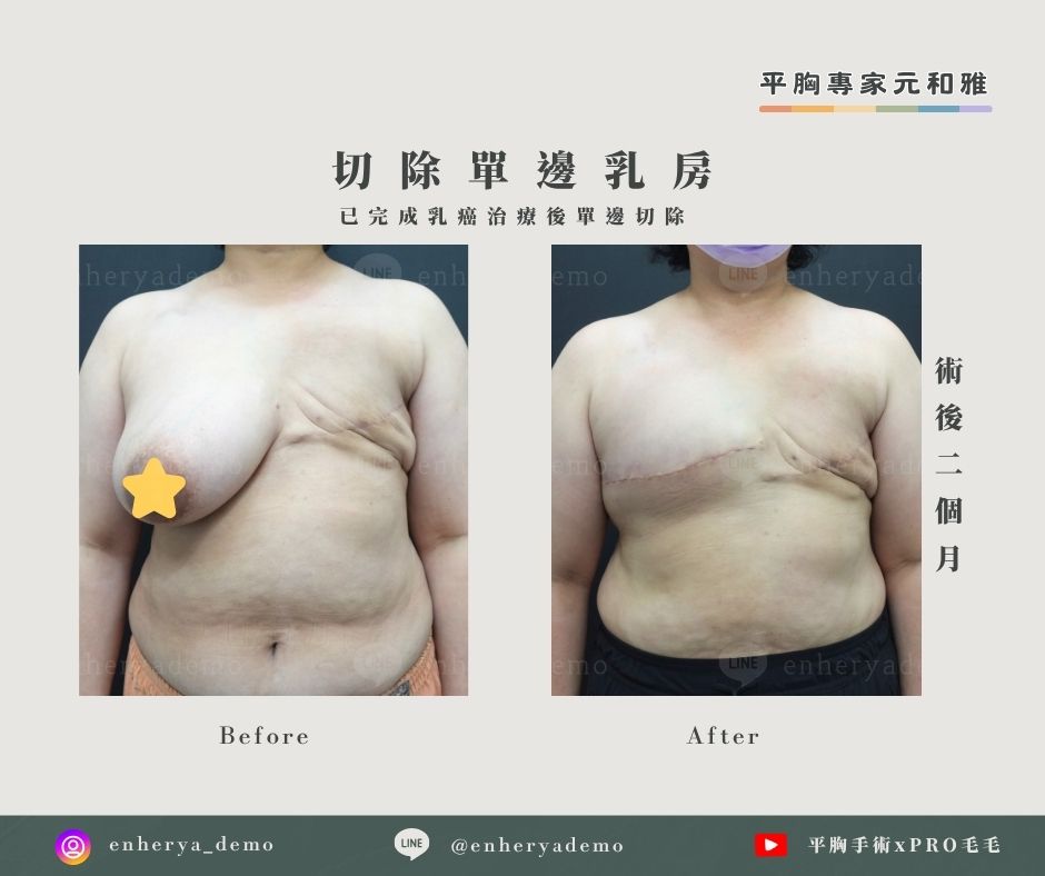 乳癌治療單邊切除手術術前術後