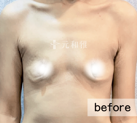 產後萎縮術前