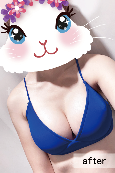 漏斗胸術後