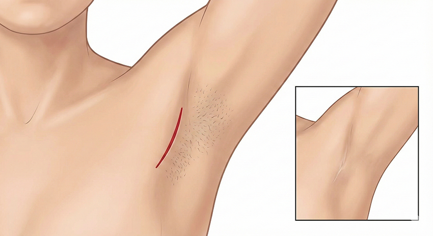 隆乳腋下切口 隆乳腋下切口