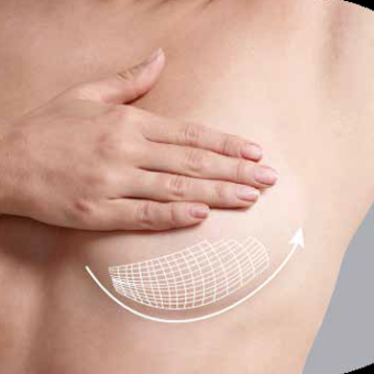 New technology in breast augmentation: a comprehensive analysis of the attractive invisible bra GalaFLEX™ | Key to long-lasting support and prevention of sagging after surgery.