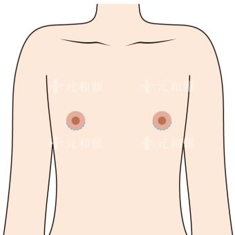 平胸手術乳暈切口vs胸下緣切口,到底哪種適合我?一文解析優缺點!