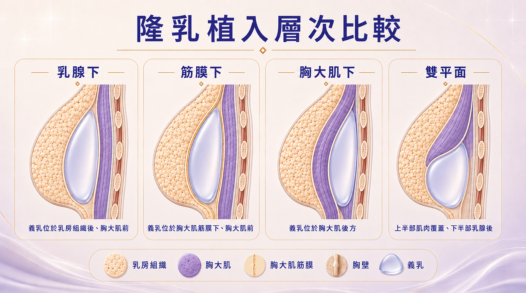 四種隆乳植入層次比較