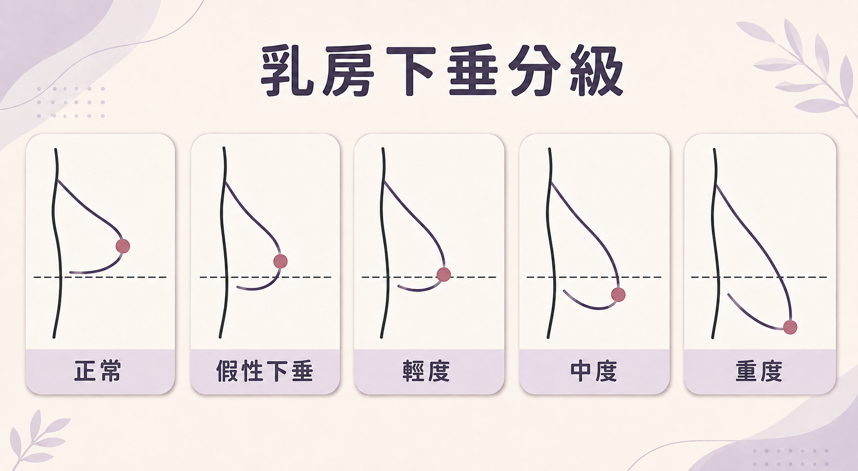 提乳手術：如何初步自我評估「乳房下垂分級圖」