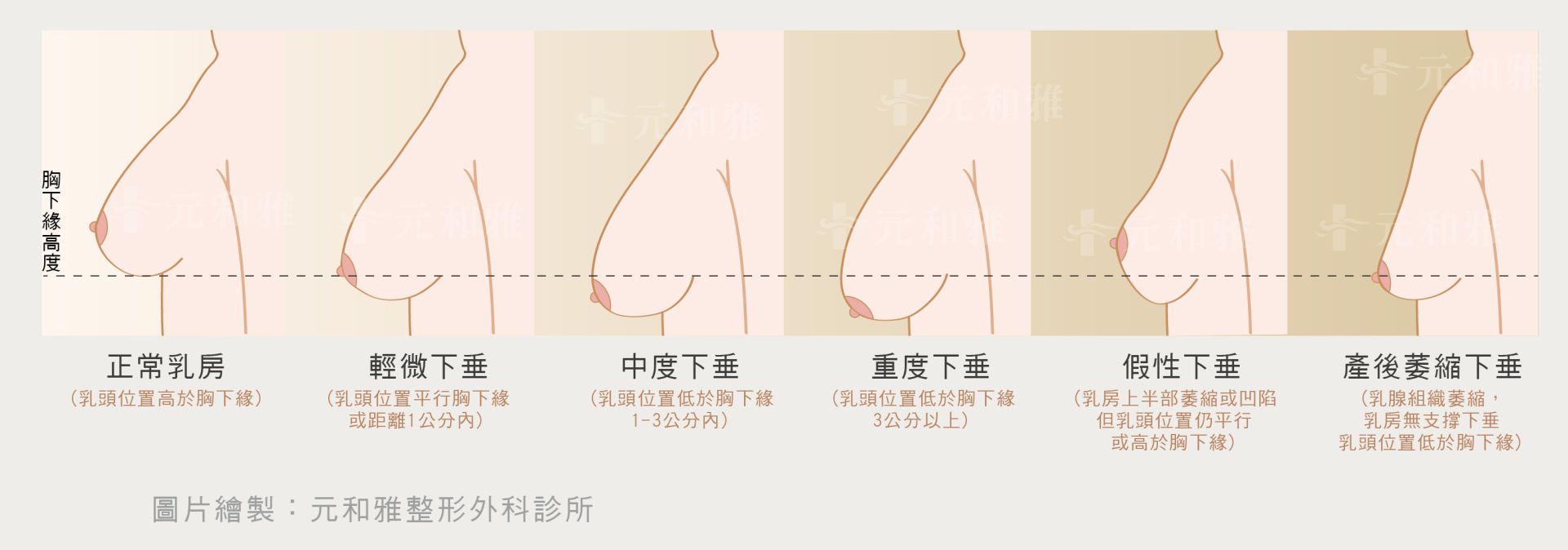 乳房下垂自我檢測表