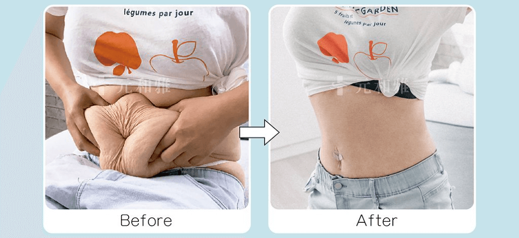 ALL_template_25L02_J1wZRhx3W0 腹部拉皮手術前後對比圖