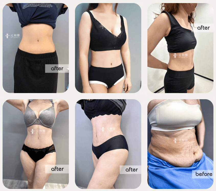 腹部拉皮手術前後對比照5 腹部拉皮手術前後對比照5