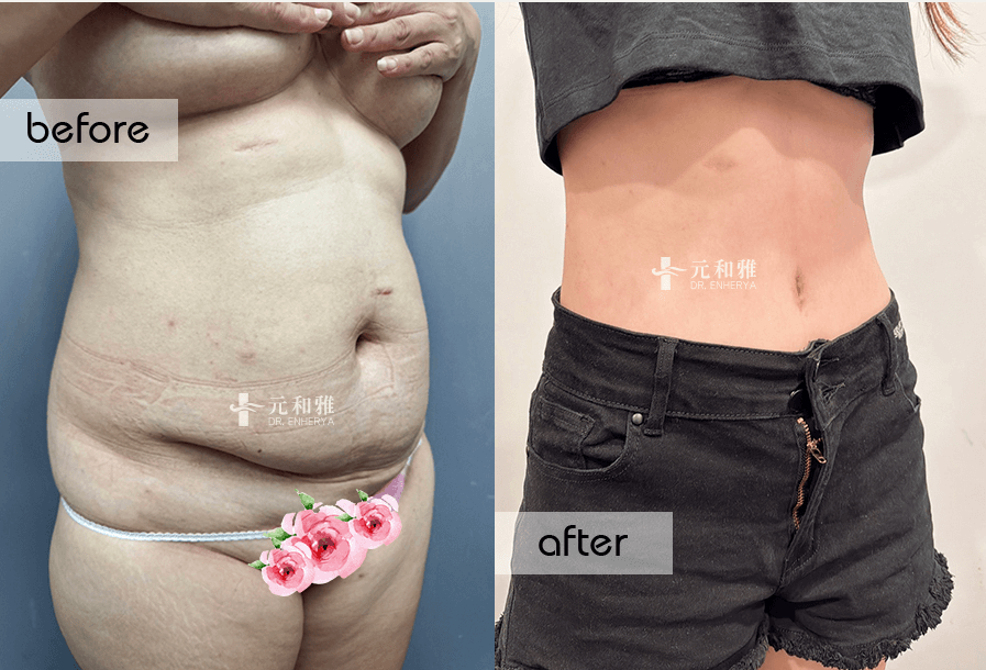 腹部拉皮手術前後對比照2 腹部拉皮手術前後對比照2