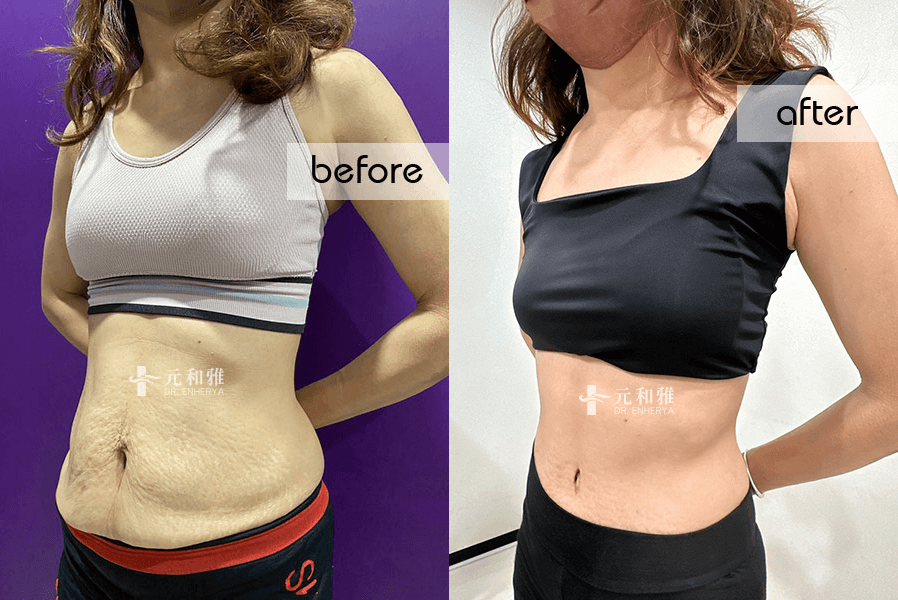 腹部拉皮手術前後對比照3 腹部拉皮手術前後對比照3