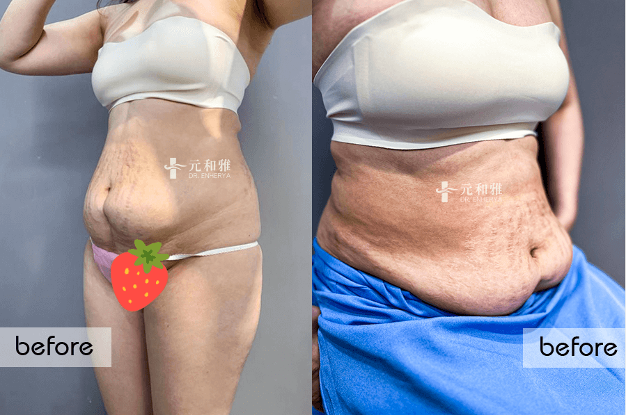 腹部拉皮手術前後對比照4 腹部拉皮手術前後對比照4