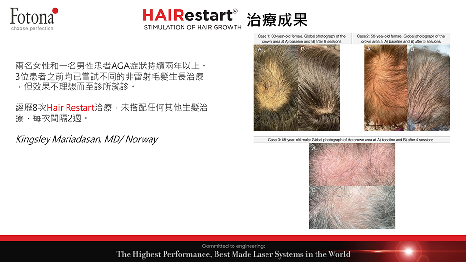 HAIRestart&reg;X生髮梳治療術後對比圖