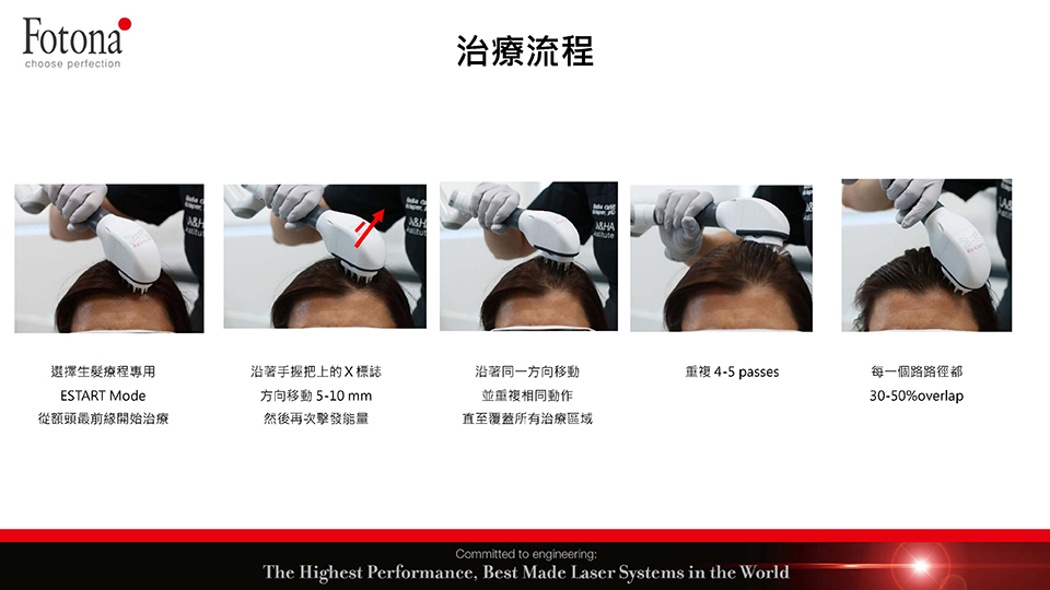 HAIRestart&reg;X生髮梳治療