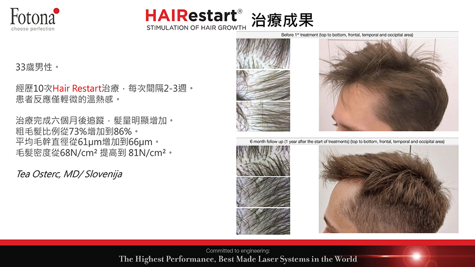 HAIRestart&reg;X生髮梳治療術後對比圖
