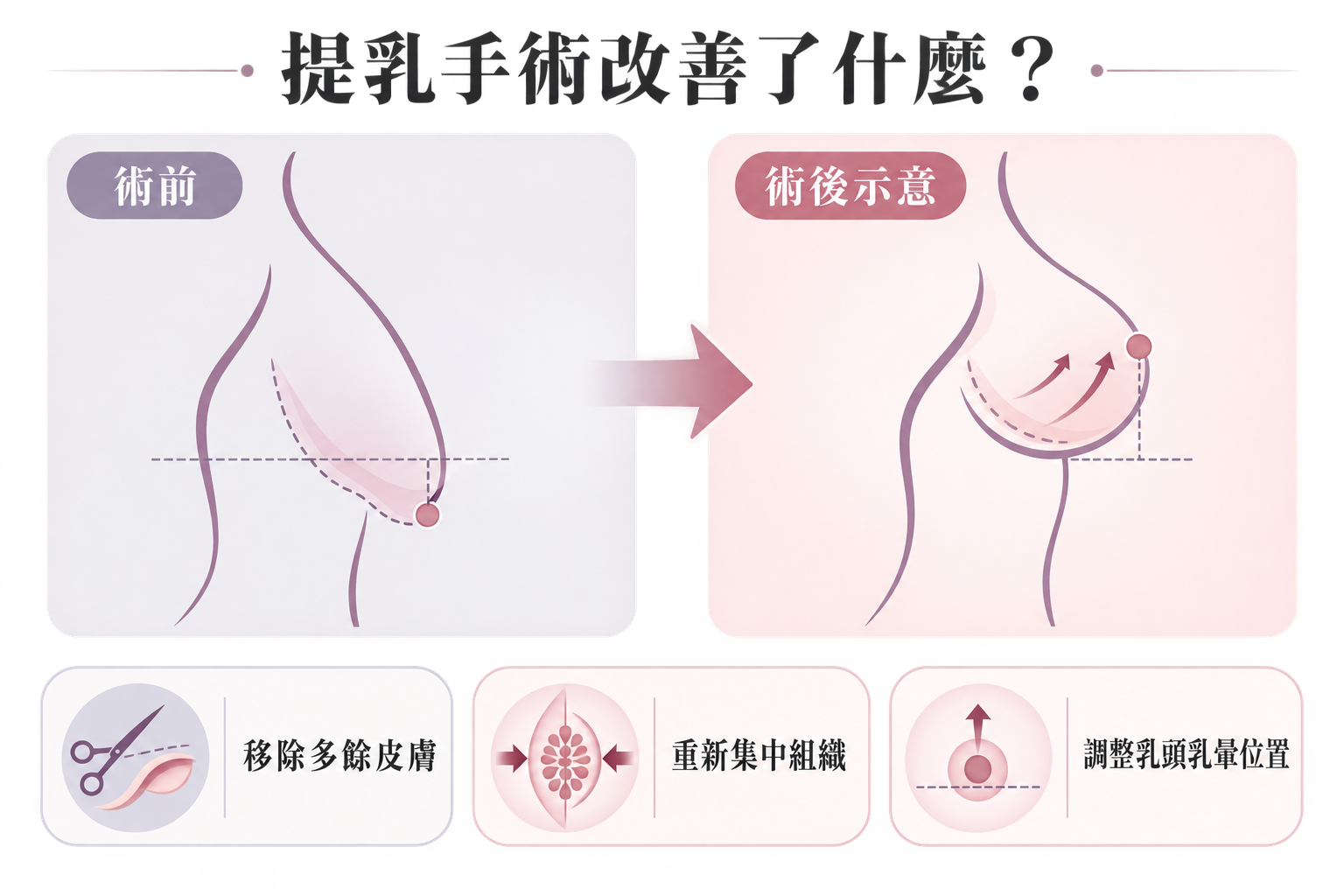 提乳手術改善了什麼?術前術後圖