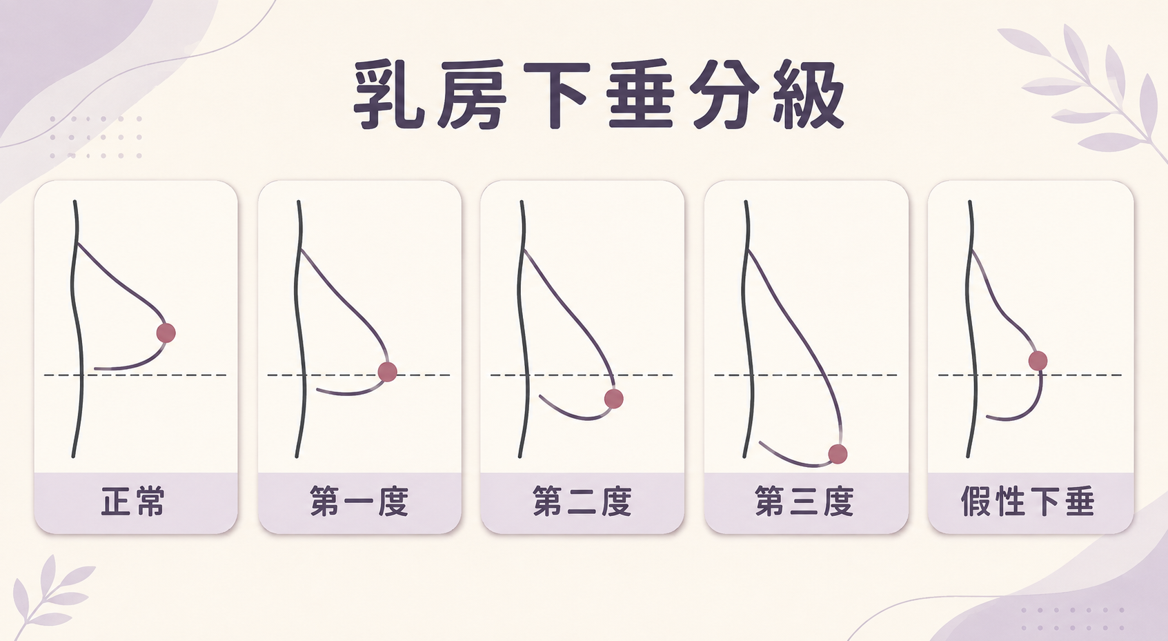 提乳手術：如何初步自我評估「乳房下垂分級圖」