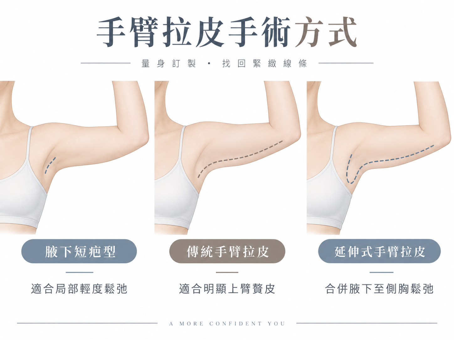 手臂拉皮手術有哪些方式？三種常見切口完整介紹