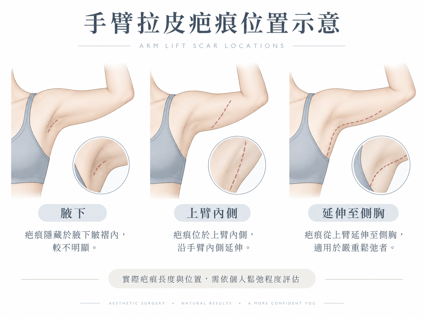 手臂拉皮疤痕在哪裡？會很明顯嗎？