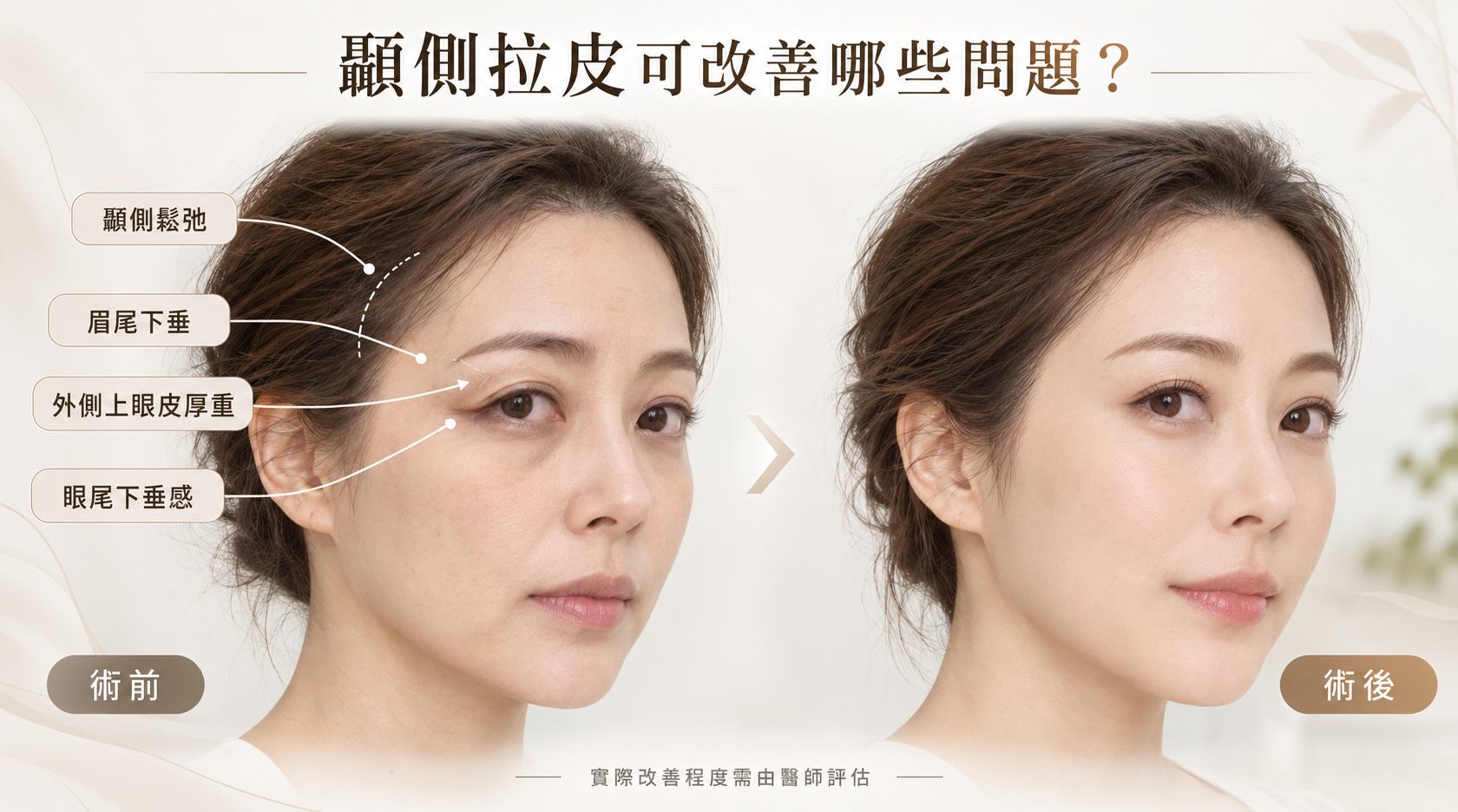 顳側拉皮可以改善哪些問題？