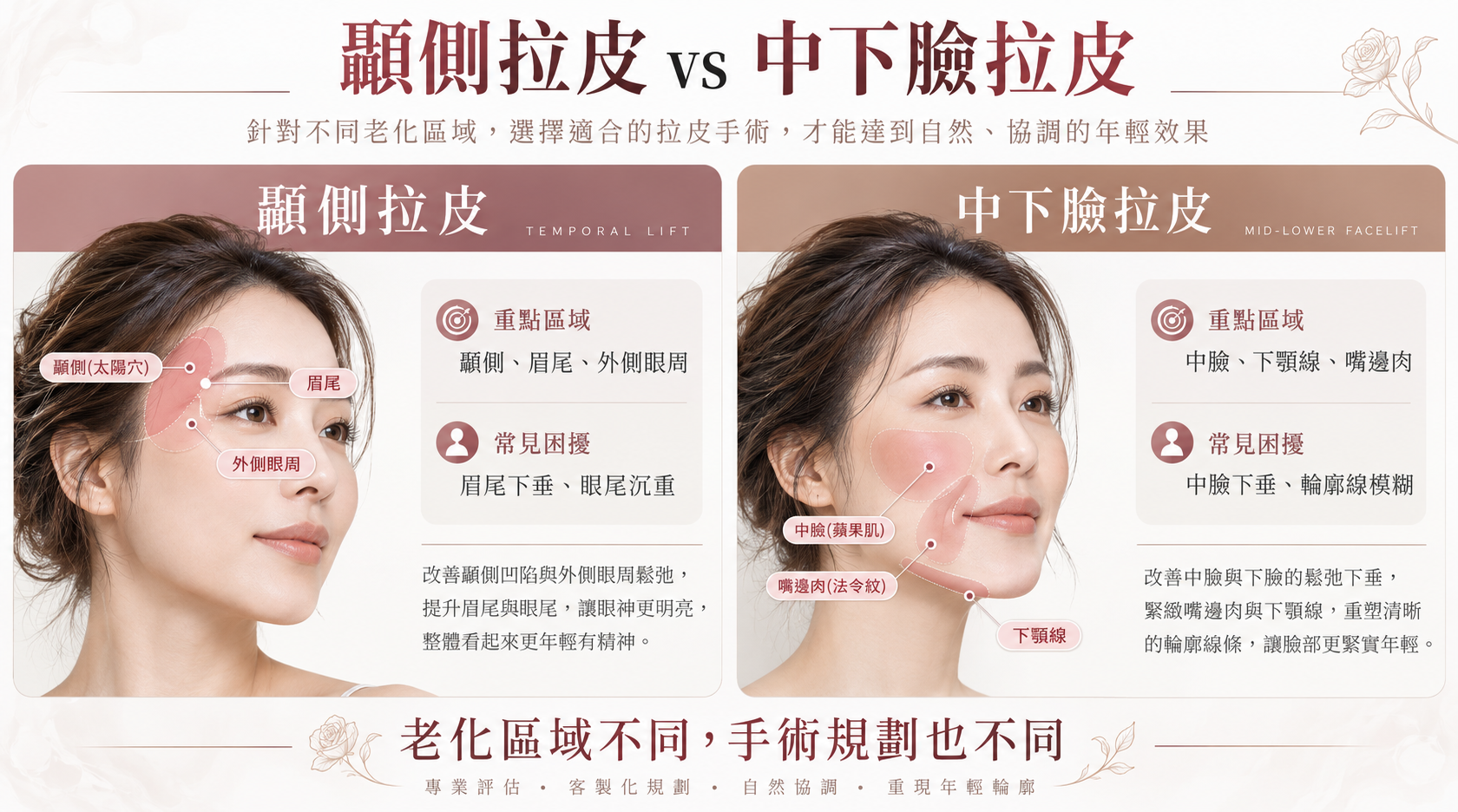 3D顳側定錨拉皮與中下臉筋膜拉皮有什麼不同？