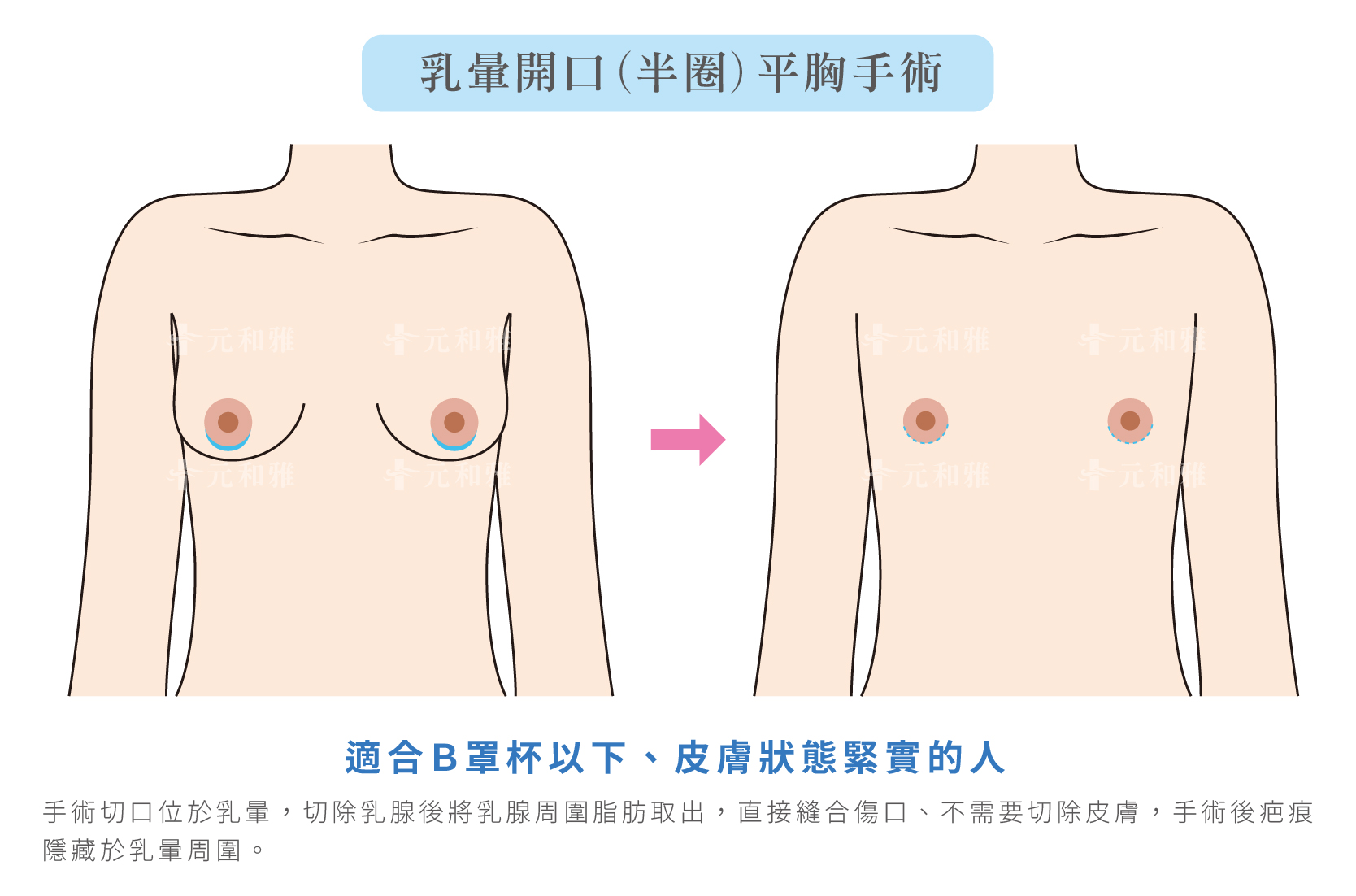 乳暈開口(半圈)平胸手術