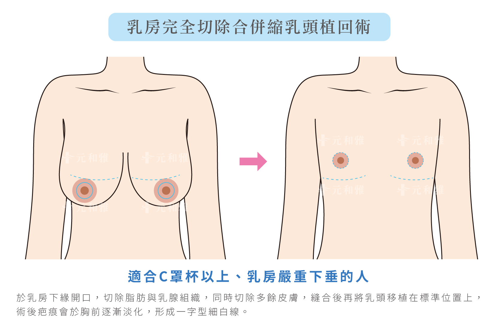 乳暈開口(翅膀型)平胸手術